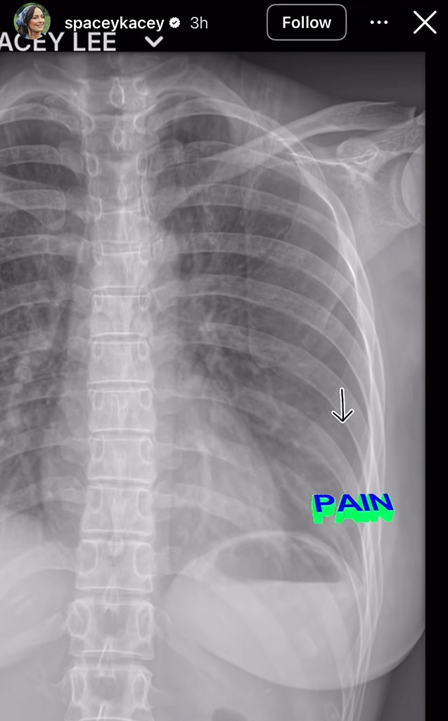 Kacey Musgraves Breaks Rib