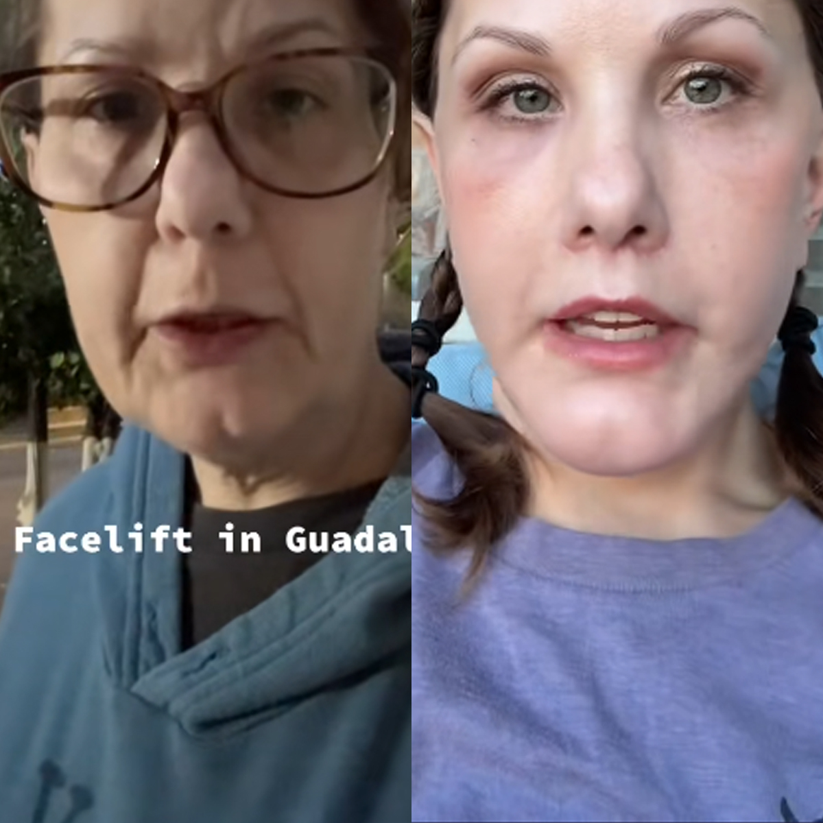 TikToker Michelle Wood’s Facelift Photos: Before and After