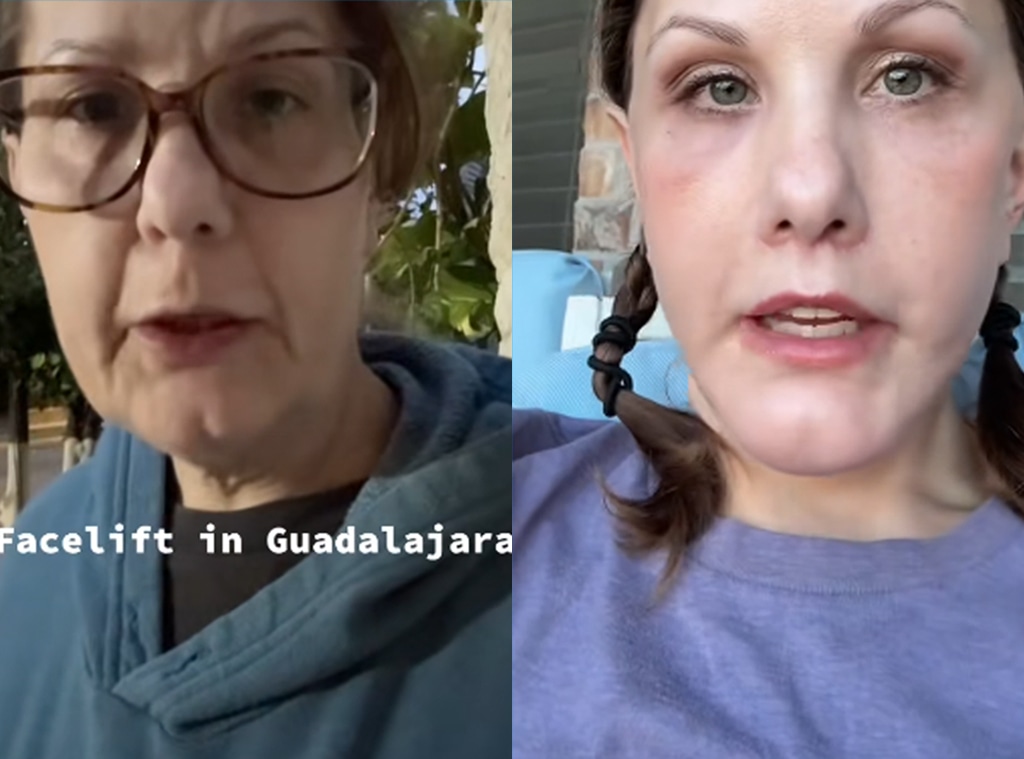 TikToker Michelle Wood's Facelift Photos: Before and After