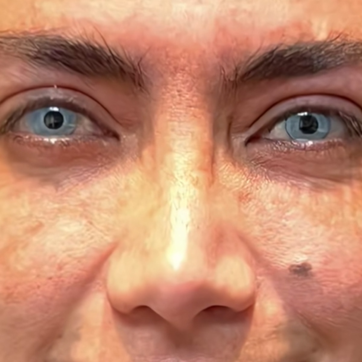 New Cosmetic Surgery Trend Permanently Changes Your Eye Color