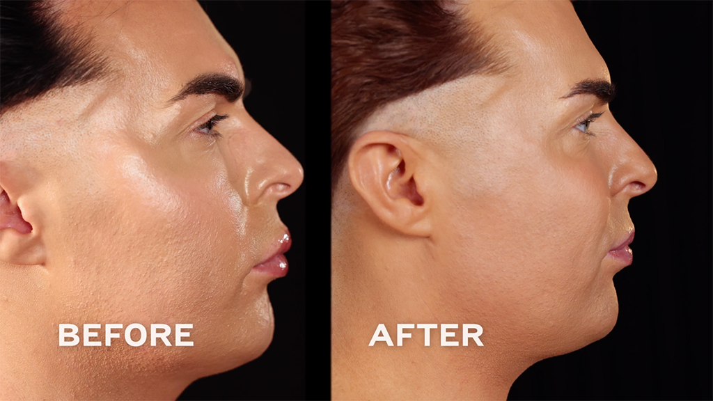 Botched Presents: Plastic Surgery Rewind Before & After Photos