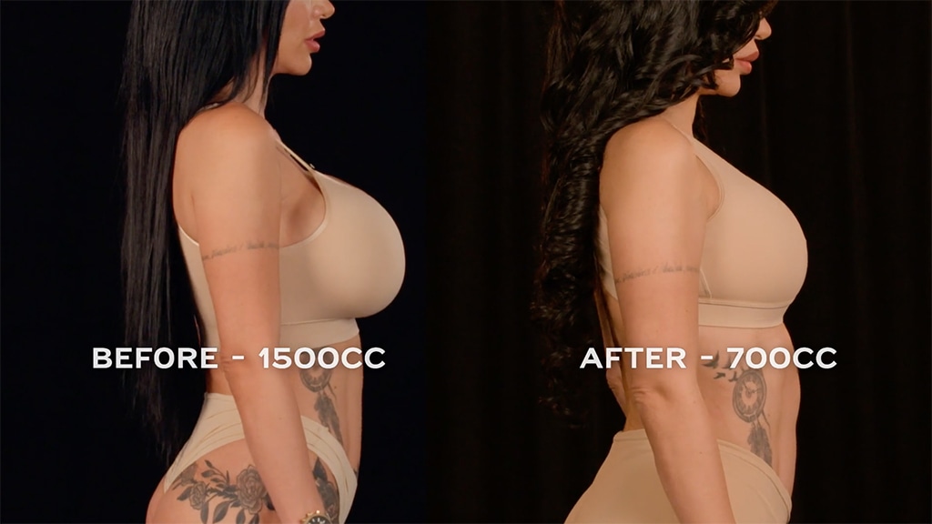 Botched Presents: Plastic Surgery Rewind Before & After Photos