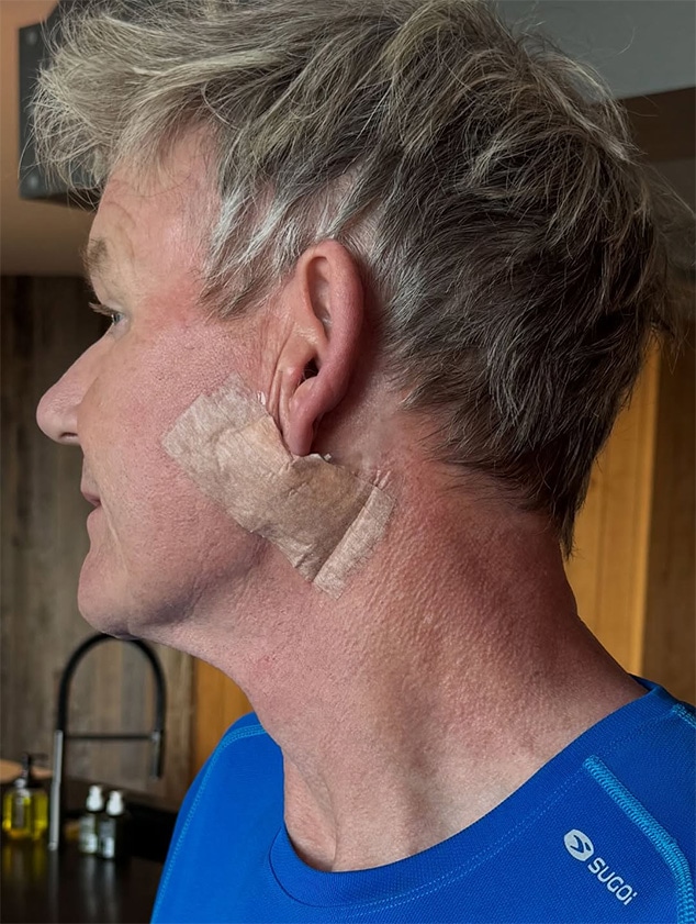 Gordon Ramsay shares skin cancer diagnosis
