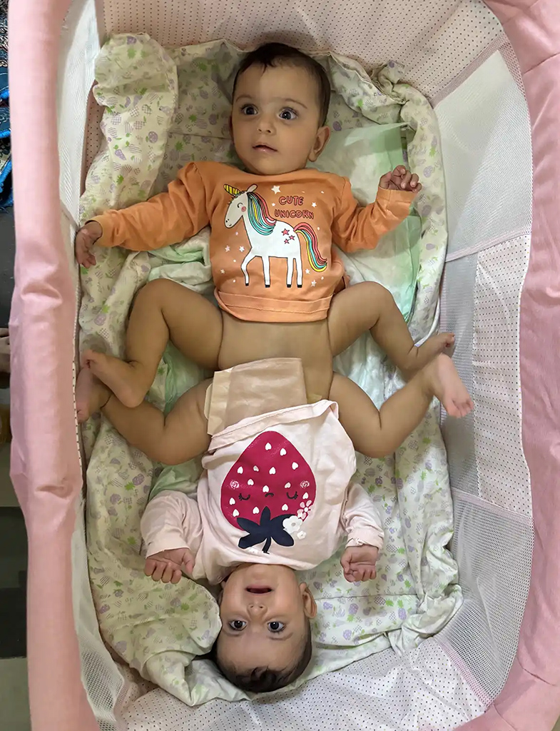 Conjoined Twins Ally and El Separated After Surgery