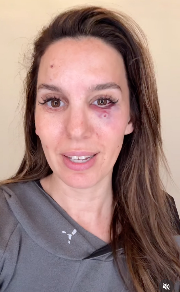 Christy Carlson Romano shot in the face