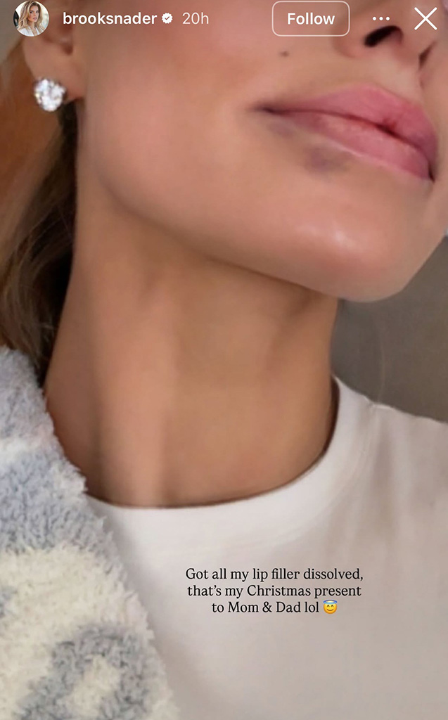 Brooks Nader Dissolves Lip Filler 