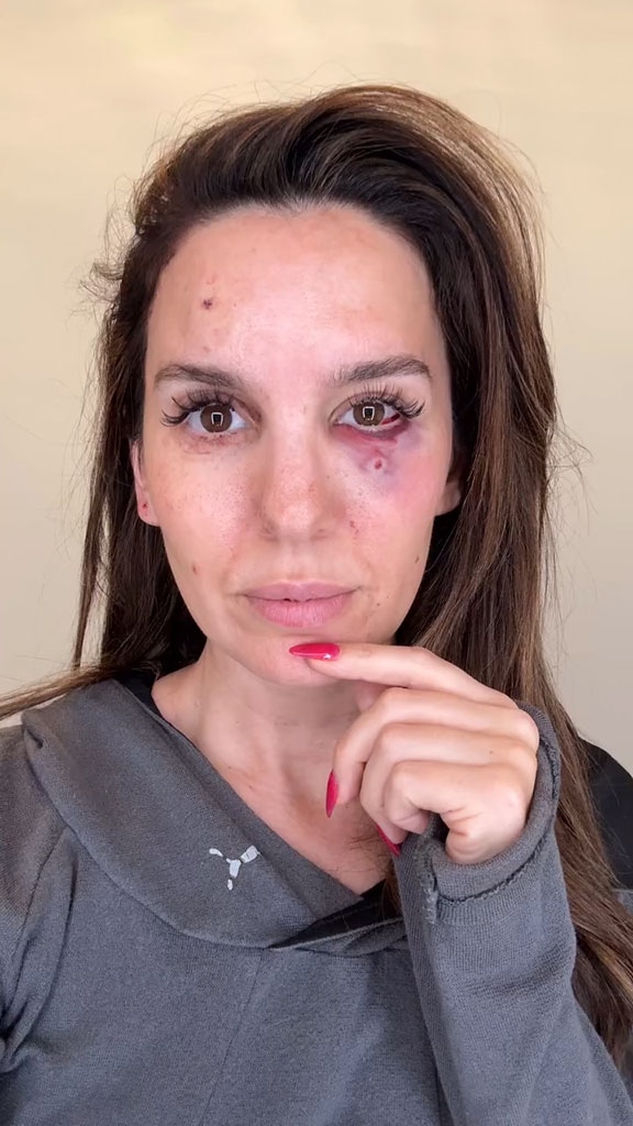 Christy Carlson Romano, Eye Injury, Instagram, 2025