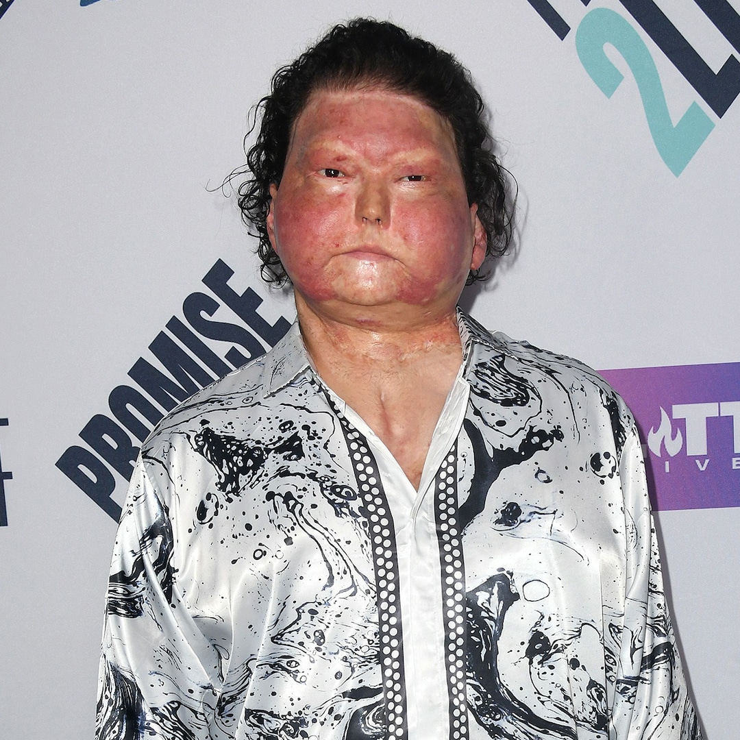 TikToker Joe DiMeo detalla su trasplante de rostro después de un accidente automovilístico y quemaduras corporales