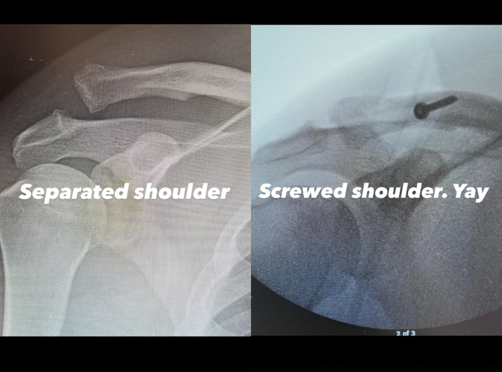 Channing Tatum Undergoes Shoulder Surgery